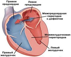 болезни сердца 1